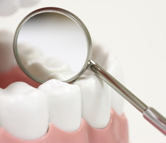 Closeup of smile with dental sealants placed during dental checkups and teeth cleanings