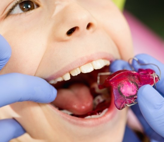 Dentist placing orthodontic device to address single tooth malalignment