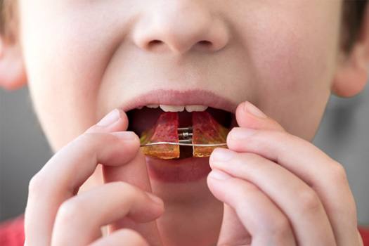 Closeup of child inserting orthodontic appliance into mouth