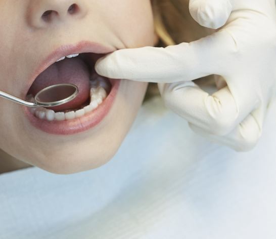 Dentist examining child's smile after tooth colored fillings